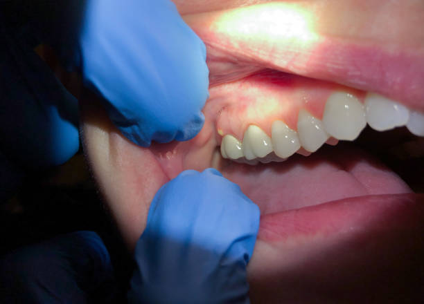 Best Emergency Wisdom Teeth Removal in Polkton, NC